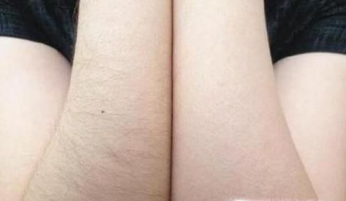 光子脱毛需要多少钱