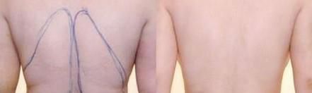 冷冻溶脂瘦背部价格