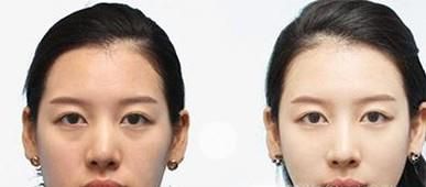超声法瘦脸价格