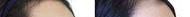 自体脂肪丰太阳穴价格