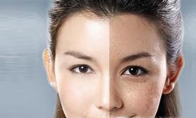 治疗黄褐斑的费用