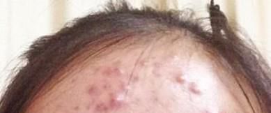 额头上长痘痘怎么治？最近长了很多小包有些还红