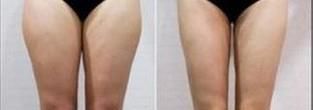 大腿吸脂对皮肤会有伤害吗