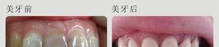 牙齿纠正多少钱