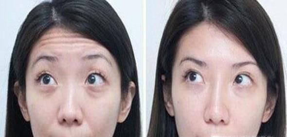 做去抬头纹价格贵吗