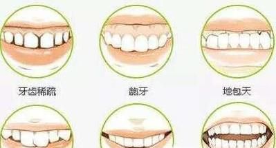 地包天牙齿矫正术后护理事项