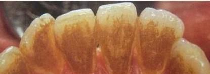 四环素牙如何变白