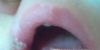 舌头上长疱疹怎么治