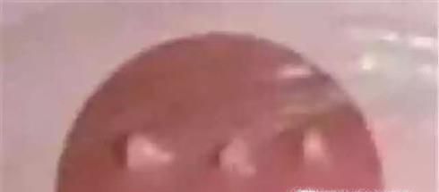 尖锐湿疣挂什么科？
