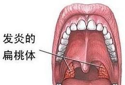扁桃体炎怎么治疗