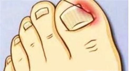 指甲夹伤后发黑怎么办