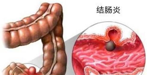 慢性结肠炎的症状是什么