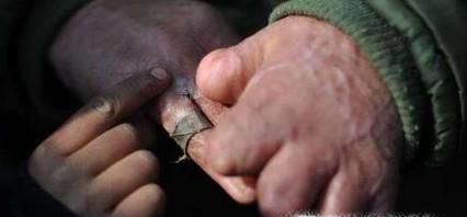 手脱皮怎么办？最简单治疗方法