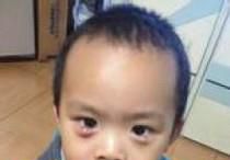 如何快速治愈“针眼”