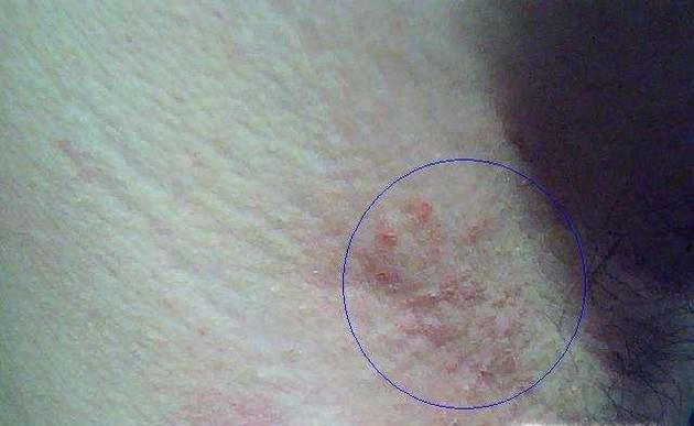 腋窝湿疹很痒怎么办