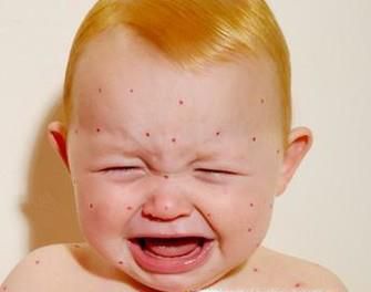 宝宝身上的疹子如何区分？
