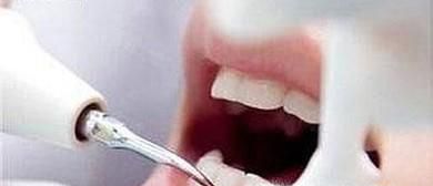 牙齿洗白要多少钱