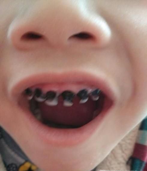 幼儿牙齿全部烂了怎么办？