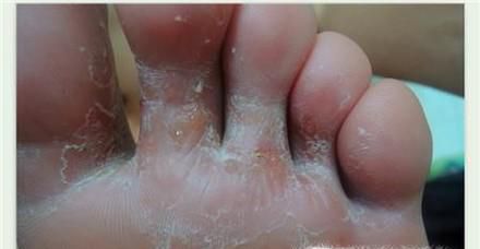 脚趾头缝里发白潮湿烂的解决方法