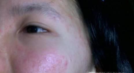 脸上过敏起痘怎么办
