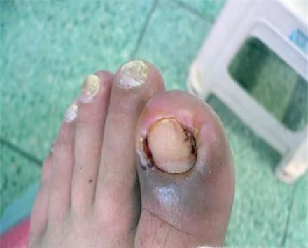 甲沟炎形成原因及正确修剪方法