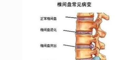 椎间盘突出症有哪些症状和图片