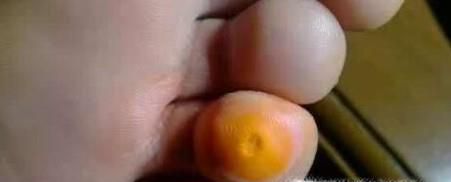 如何去除鸡眼