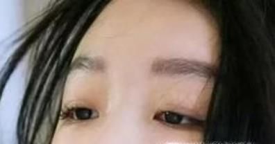 双眼皮变肿的原因有哪些？该怎样改善？