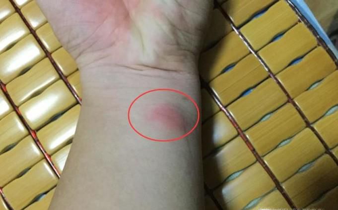 肺结核皮试结果怎么看