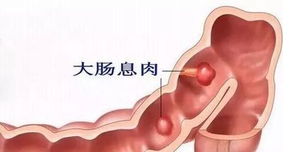 大肠息肉怎么治疗和预防，会癌变吗？