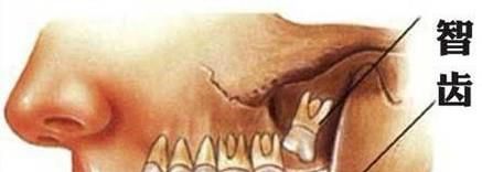 拔掉智齿阻生牙的流程步骤