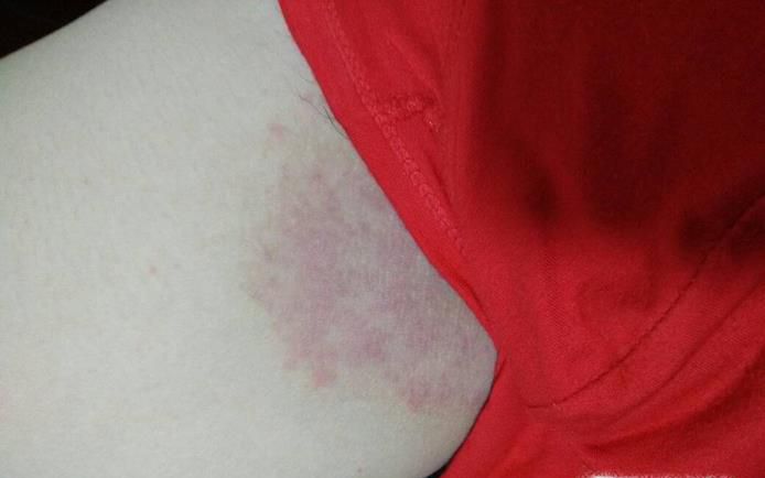 大腿内侧股癣怎么治？涂了很多药膏皮肤很黑？
