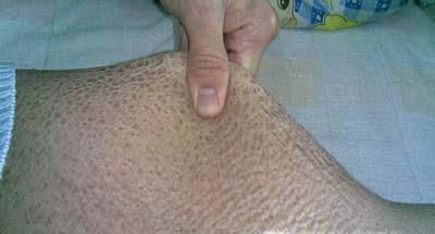 鱼鳞病的症状 鱼鳞病图片
