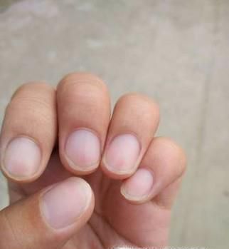 指甲有白点暗示什么疾病