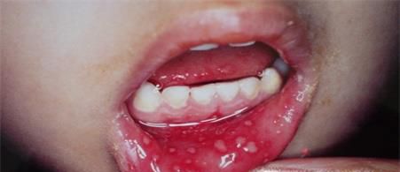 手足口病疱疹的预防