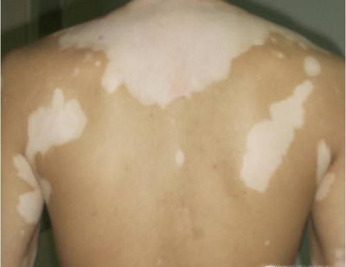 胳膊上有小白点 白斑是什么？皮肤病怎么治？