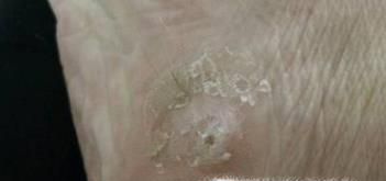 脚上长了鸡眼怎么办