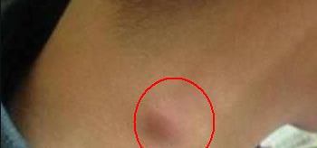 脖子上长小肉疙瘩不疼不痒是什么东西？
