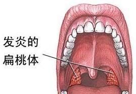 扁桃体化脓治疗方法