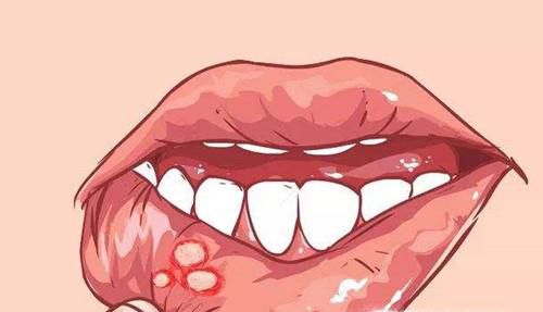 如何早期发现口腔癌