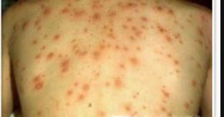 长水痘怎么办？水痘有什么症状？