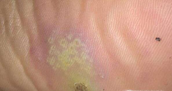 手上长了一个瘊子用什么土方法可以去掉