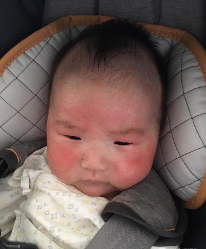 湿疹和痱子有相似处，夏季如何区分湿疹和热痱？