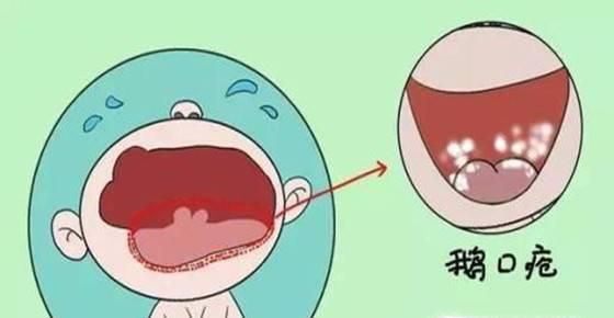 孩子得了鹅口疮都有哪些症状呢？