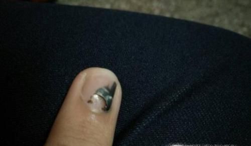 手指被门夹了如何处理