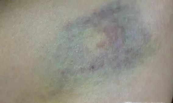 淤青怎么快速消除