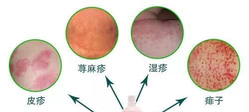 炉甘石洗剂怎么用