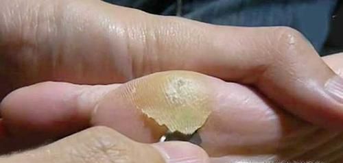 鸡眼长什么样
