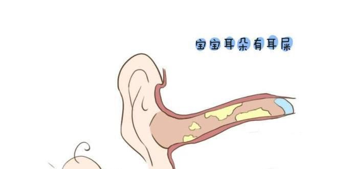 耳朵被耵聍 耳垢堵了怎么办？