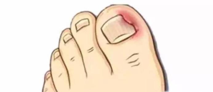 脚指甲往肉里长怎么办